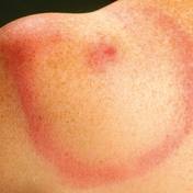 erythema migrans